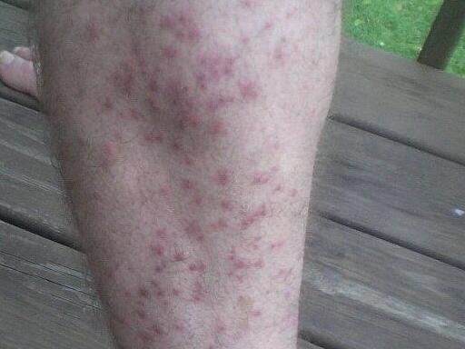 WI_bug_bites.JPG
